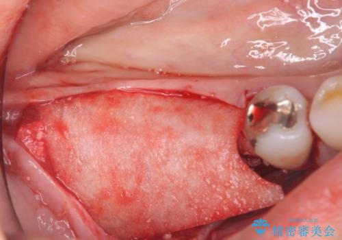 奥歯で咬めない　インプラントによる咬合回復①　骨造成　の治療中