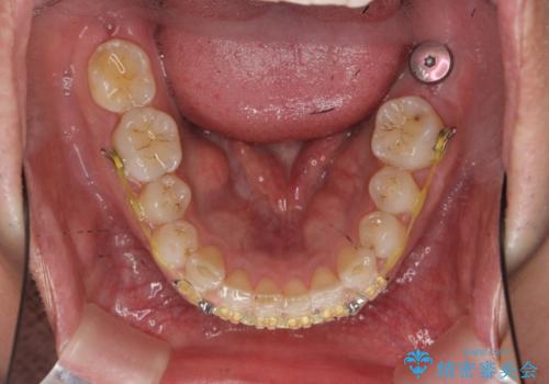 下顎前歯部のガタつきを部分矯正での治療中
