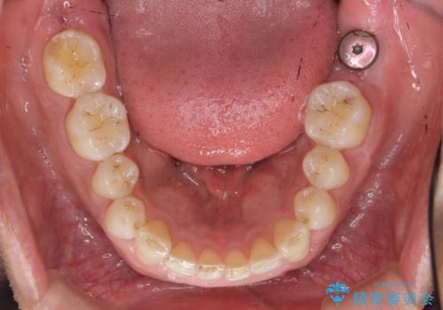 下顎前歯部のガタつきを部分矯正での治療後