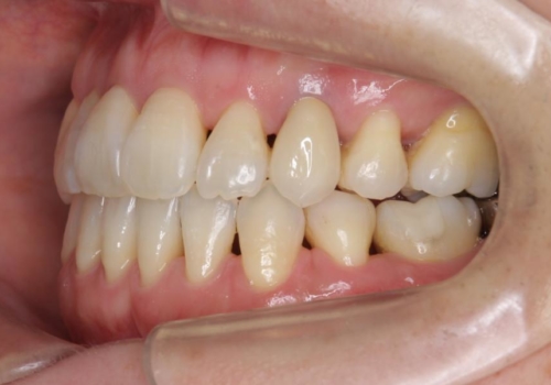 前歯のセラミッククラウン　犬歯に相当する部位に自然にの症例 治療後