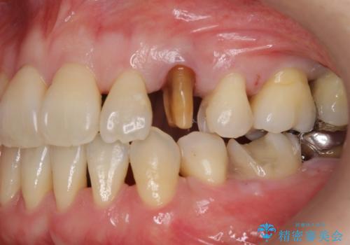 前歯のセラミッククラウン　犬歯に相当する部位に自然にの治療中