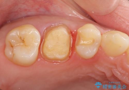 奥歯の歯の間の虫歯の治療　セラミッククラウンおよびセラミックインレーの治療中