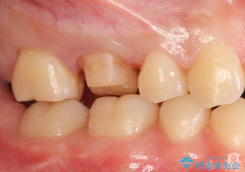 奥歯の歯の間の虫歯の治療　セラミッククラウンおよびセラミックインレーの治療中