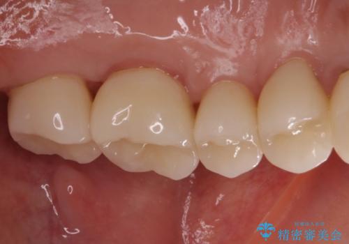 歯肉の中の深い虫歯　外科処置による適正な虫歯治療