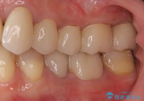 歯肉の中の深い虫歯　外科処置による適正な虫歯治療の症例 治療後