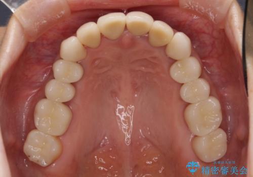 歯肉の中の深い虫歯　外科処置による適正な虫歯治療の治療後