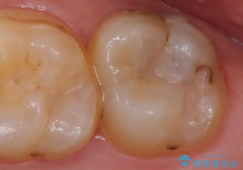 メタルボンドクラウン　虫歯治療の症例 治療前