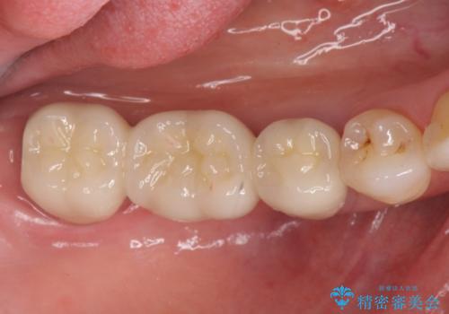 奥歯のブリッジを白く　矯正含めた総合治療で、歯周病、根の問題、一気に解決の症例 治療後