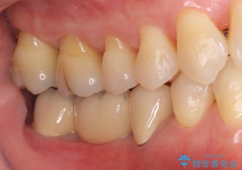 奥歯のブリッジを白く　矯正含めた総合治療で、歯周病、根の問題、一気に解決の治療後