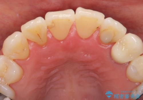 前歯のセラミッククラウン　犬歯に相当する部位に自然にの治療後
