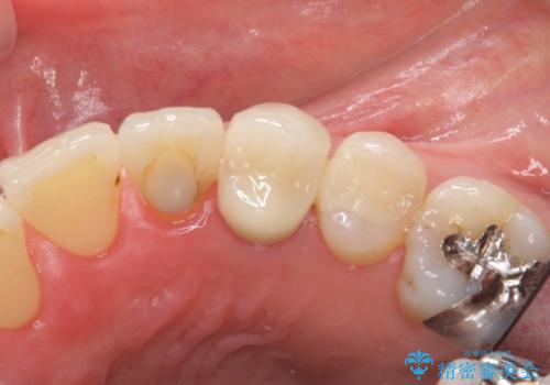 前歯のセラミッククラウン　犬歯に相当する部位に自然にの治療後