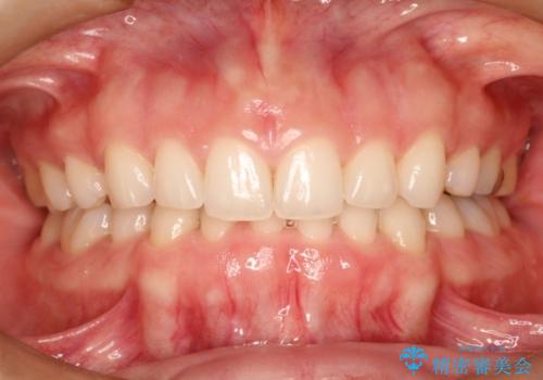 単純歯肉切除による歯のライン改善の治療前