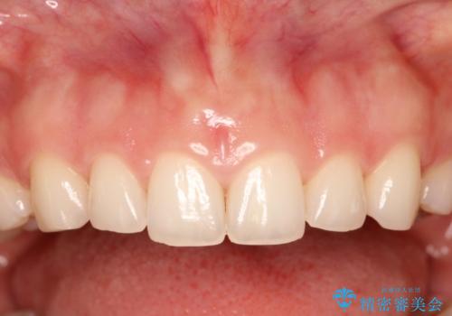 単純歯肉切除による歯のライン改善の症例 治療前