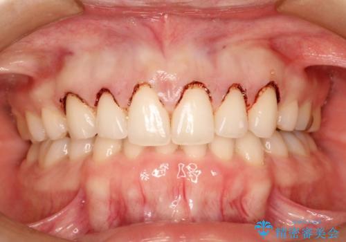 単純歯肉切除による歯のライン改善の治療中
