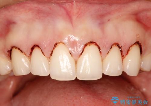 単純歯肉切除による歯のライン改善