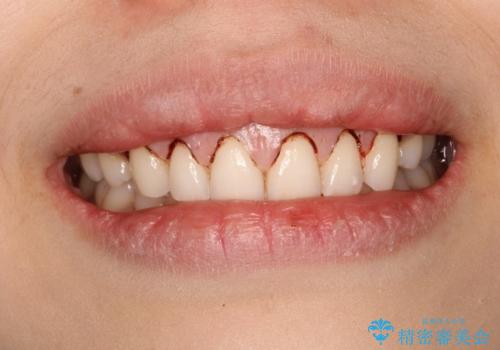 単純歯肉切除による歯のライン改善の治療中