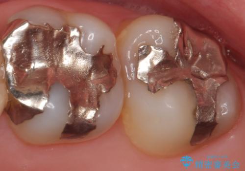 PGA(ゴールド)インレー　虫歯治療の症例 治療前