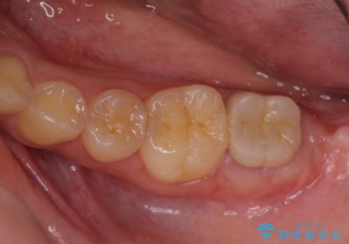 銀歯がすぐとれる　短い歯を長くするの治療後