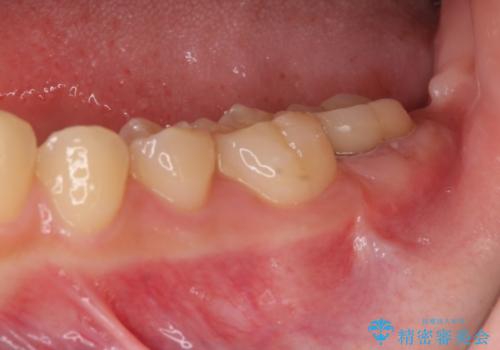 銀歯がすぐとれる　短い歯を長くするの症例 治療後