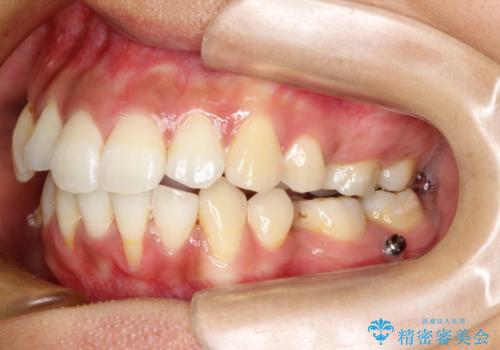 目立たない装置で前歯のデコボコを改善　リンガル装置の抜歯矯正の治療中
