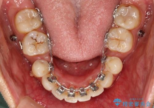 目立たない装置で前歯のデコボコを改善　リンガル装置の抜歯矯正の治療中