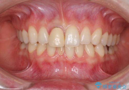 変色した保険診療の前歯をオールセラミックできれいにの治療前