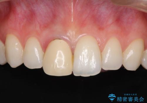 変色した保険診療の前歯をオールセラミックできれいにの症例 治療前