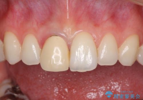 変色した保険診療の前歯をオールセラミックできれいにの治療前