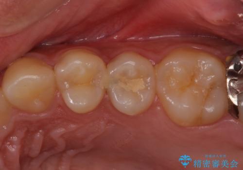 歯の内部が黒く変色し痛む　大きな虫歯のセラミックインレー治療の治療前