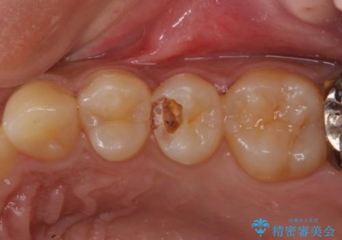 歯の内部が黒く変色し痛む　大きな虫歯のセラミックインレー治療の治療前