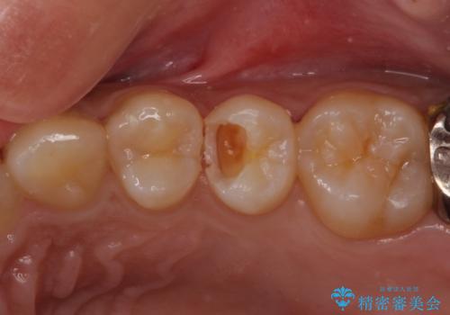 歯の内部が黒く変色し痛む　大きな虫歯のセラミックインレー治療