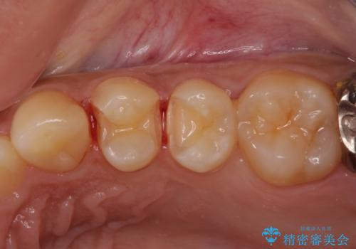 歯の内部が黒く変色し痛む　大きな虫歯のセラミックインレー治療の治療中