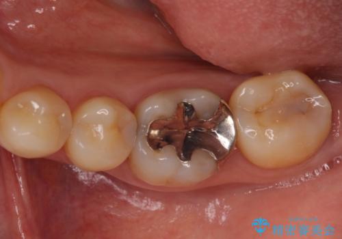 奥歯の虫歯をゴールドインレーで修復治療の治療前
