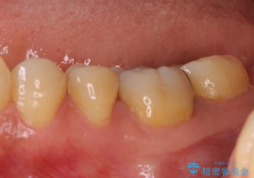 奥歯の虫歯をゴールドインレーで修復治療の治療前