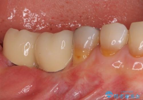 奥歯で咬めない　インプラントによる咬合回復②　歯肉移植・補綴の治療後