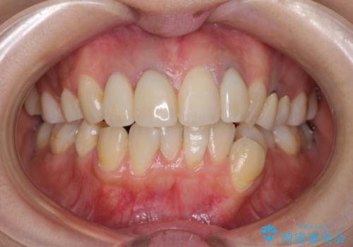 前歯の被せ物装着前のホワイトニングの症例 治療前