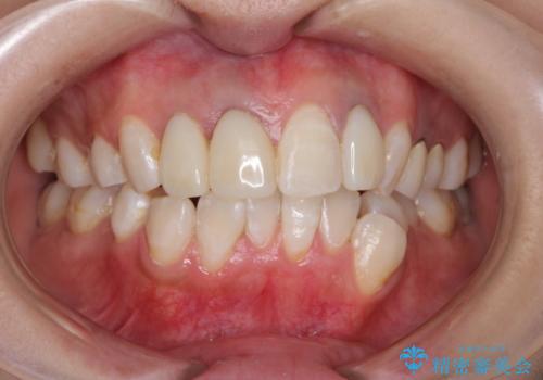 前歯の被せ物装着前のホワイトニングの症例 治療後