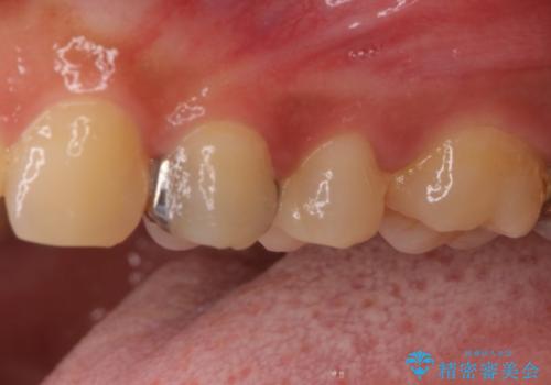 歯の内部が黒く変色し痛む　大きな虫歯のセラミックインレー治療の治療後