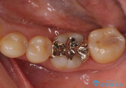 奥歯の虫歯をゴールドインレーで修復治療の症例 治療後