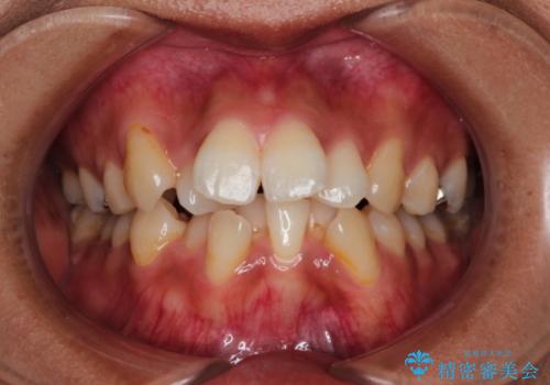 目立たない装置で前歯のデコボコを改善　リンガル装置の抜歯矯正の症例 治療前