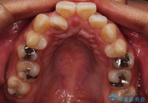目立たない装置で前歯のデコボコを改善　リンガル装置の抜歯矯正の治療前