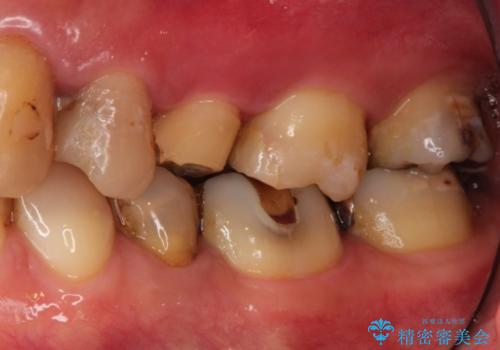 歯肉の中の深い虫歯　外科処置による適正な虫歯治療の治療前