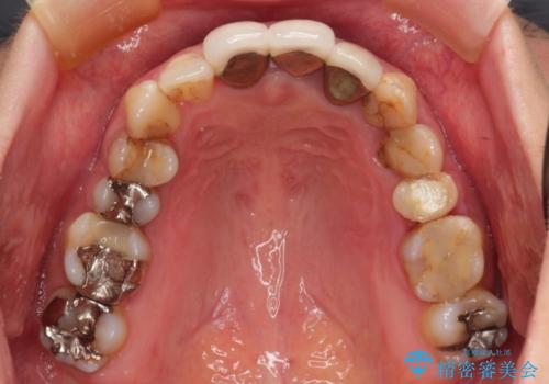 歯肉の中の深い虫歯　外科処置による適正な虫歯治療の治療前