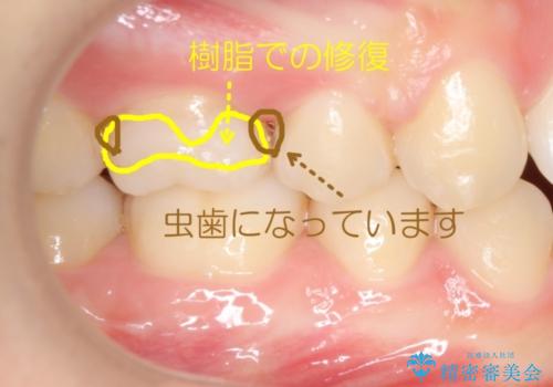 奥歯の歯の間の虫歯の治療　セラミッククラウンおよびセラミックインレー