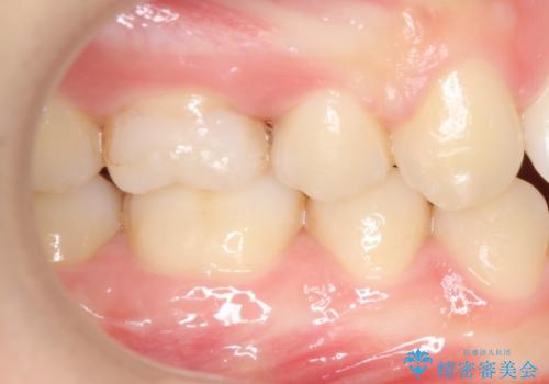 奥歯の歯の間の虫歯の治療　セラミッククラウンおよびセラミックインレーの症例 治療前