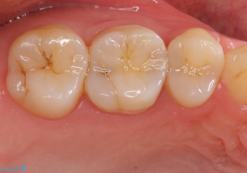 奥歯の歯の間の虫歯の治療　セラミッククラウンおよびセラミックインレーの治療前