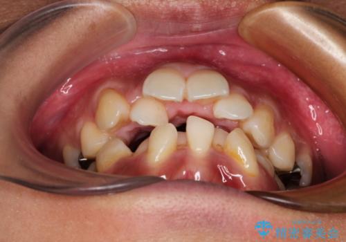 目立たない装置で前歯のデコボコを改善　リンガル装置の抜歯矯正の治療前