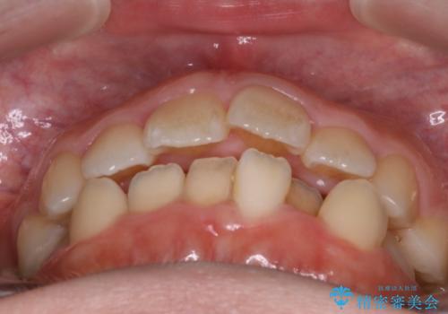 インビザラインinvisalignによる軽度ガタつきの歯列矯正治療の治療前