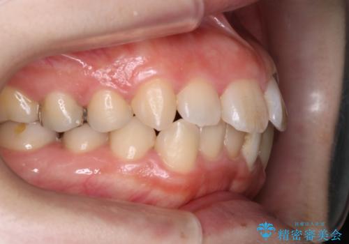 インビザラインinvisalignによる軽度ガタつきの歯列矯正治療の治療前