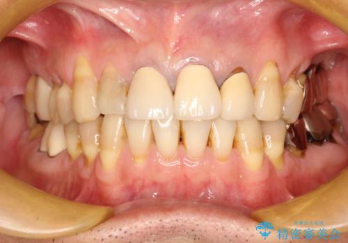 上の前歯を根の治療からの再補綴